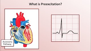 Advanced EKGs  WolffParkinsonWhite WPW Syndrome [upl. by Audsley]