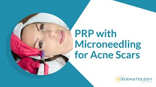 PRP with Microneedling for Acne Scars [upl. by Liatrice]