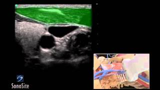 How To Ultrasound Guided Insertion Internal Jugular Catheter Trans  Sonosite Ultrasound 3D Video [upl. by Osbert62]