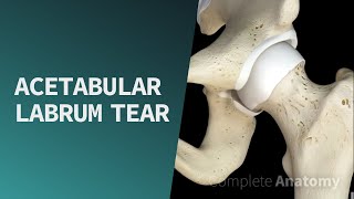 Acetabular Labrum Tear  Pathologies [upl. by Lib]