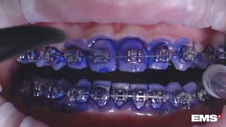 Cleaning Orthodontic Appliances with GBT Guided Biofilm Therapy [upl. by Jud900]