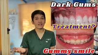 GUMMY SMILE DARK GUMS and UNEVEN TEETH Treaments Gingivectomy Gum Bleaching and Enameloplasty [upl. by Acirrej378]