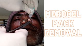 Merocel pack removal [upl. by Madi]