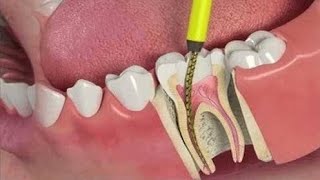 INCREDIBLE Reconstruction Of PoorFailed Root Canal Treated Toothvideo [upl. by Arised]