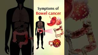 symptoms of bowel cancer shorts [upl. by Acinet205]