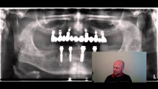 Oberkiefer Implantate auch ohne Knochenaufbau möglich [upl. by Wappes]