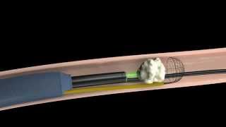 Calculo Renal Tratamiento mediante fragmentacion interna Urologia Peruana [upl. by Kinom]