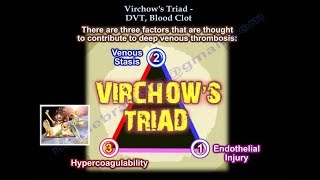 DVT amp Virchows Triad  Everything You Need To Know  Dr Nabil Ebraheim [upl. by Aikal]