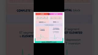 STEMI vs NSTEMI [upl. by Aysab]