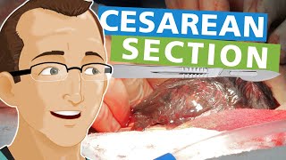 Cesarean Section [upl. by Yenruoc]