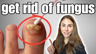 Get Rid Of Toenail Fungus With These 4 Easy Home Remedies [upl. by Rubma784]