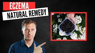 Best Natural Remedy for Eczema [upl. by Pavel793]