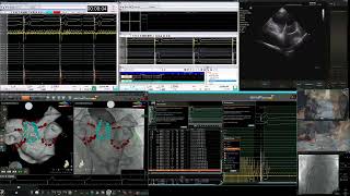 Centauri PFA Ablation Live Case Recording  Southlake Regional Health Centre  Newmarket Ontario [upl. by Meenen]