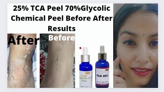 25 TCA peel 70 Glycolic peel Before After Results HandLegsBody Chemical peelIn Hindi [upl. by Lyndel370]