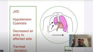 Tension Pneumothorax Pathophysiology Etiology and Treatment in the Prehospital Setting [upl. by Alyda]