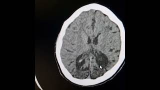 Bilateral chronic occipitoparietal infarctsDystrophic calcifications thickened adjacent calvarium [upl. by Mayda366]