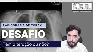 Tem algo errado nesta Radiografia de Tórax Você consegue dizer o que é  Galvani Filho [upl. by Rollie500]