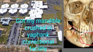 Got my jaw broke in the Yaphank correctional facility You win some you lose some [upl. by Octavia520]