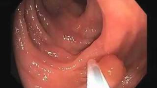 Colonoscopy Video Tour Removal of a Colon Polyp Polypectomy [upl. by Berwick]