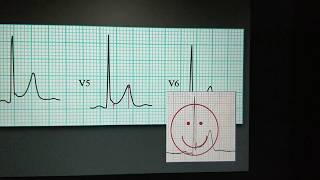 Myocardial ischemia ECG class [upl. by Michaela]