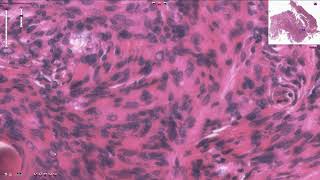 Meningioma  Histopathology [upl. by Lunt]