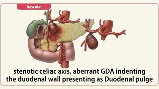 Stenotic celiac axis aberrant GDA indenting the duodenal wall presenting as Duodenal pulge [upl. by Dhar]