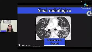 NÓDULOS PULMONARES NA TC DE TÓRAX COMO EU AVALIO [upl. by Asiat]