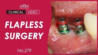 45 46 Implant placement with Flapless surgery Dr Cho Yongseok [upl. by Reteip]