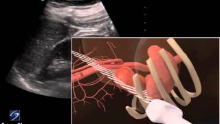 3D How To Left Kidney Ultrasound  SonoSite Ultrasound [upl. by Enidaj978]