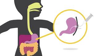 Understanding feeding tubes  Childrens Wisconsin [upl. by Assirat980]