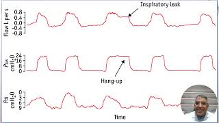 Monitoring In Acute NIV [upl. by Hajidak]