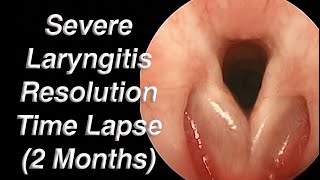 Acute to Chronic Laryngitis Resolution Time Lapse 2 Months [upl. by Aryad]