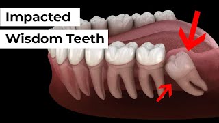 Impacted Wisdom Tooth Removal [upl. by Bodwell]