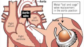 Pyrolytic Carbon Heart Valves  Graphene MCV [upl. by Nye]