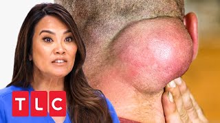 Ein Tumor im Nacken  Dr Pimple Popper  TLC Deutschland [upl. by Aiynat847]