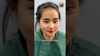 Love Shaped Hair Line Transplant  GLOJAS AESTHETIC CLINIC [upl. by Amairam691]