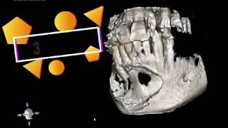 Mandibular Cyst [upl. by Tompkins]