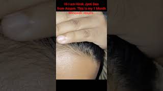 My 1 Month Minoxidil Results😍  Baby Hair Started to Come☑️❤ minoxidil minoxidilresult health [upl. by Ydnec]