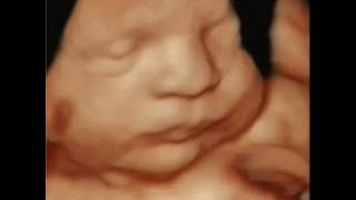 PERFECT 33 Week Baby in 3D4D amp HDlive ULTRASOUND A NEW CONCEPTION ULTRASOUND STUDIO IN MA [upl. by Ihp]