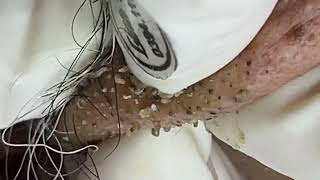 Acne treatment for Spa Linh Mun 2023 004 [upl. by Ydnagrub]