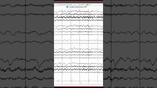 EEG captures Asystole eeg epilepsy [upl. by Onfre930]