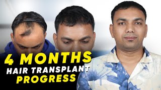 Hair Transplant in Satara  Best Results amp Cost of Hair Transplant in Satara [upl. by Hedda772]