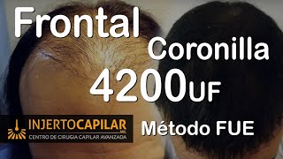 Cirugia x Metodo FUE  4200 Uf en 2 cirugías [upl. by Peedsaj]