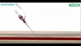 ArterioSel  Safe Simple Successful Arterial Cannulation [upl. by Priestley]