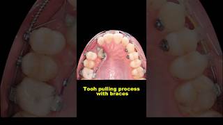 Pulling out hidden teeth when braces braces orthodontist dentist bracesoff [upl. by Nnaeiluj481]