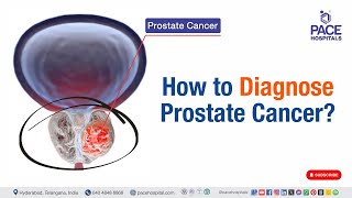 Prostate Cancer Diagnosis  How to Diagnose Prostate Cancer  prostatecancer [upl. by Ylurt800]