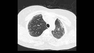 Fibrose pulmonar idiopática PIU [upl. by Chimene]