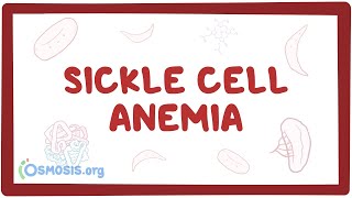 Sickle cell anemia  causes symptoms diagnosis treatment amp pathology [upl. by Micah]