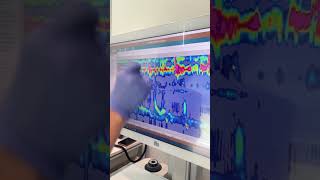 Esophageal Manometry Test with Austin Gastro November 2024 [upl. by Lleynad]