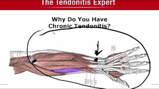 Why Do You Have Chronic Tendonitis [upl. by Tan]